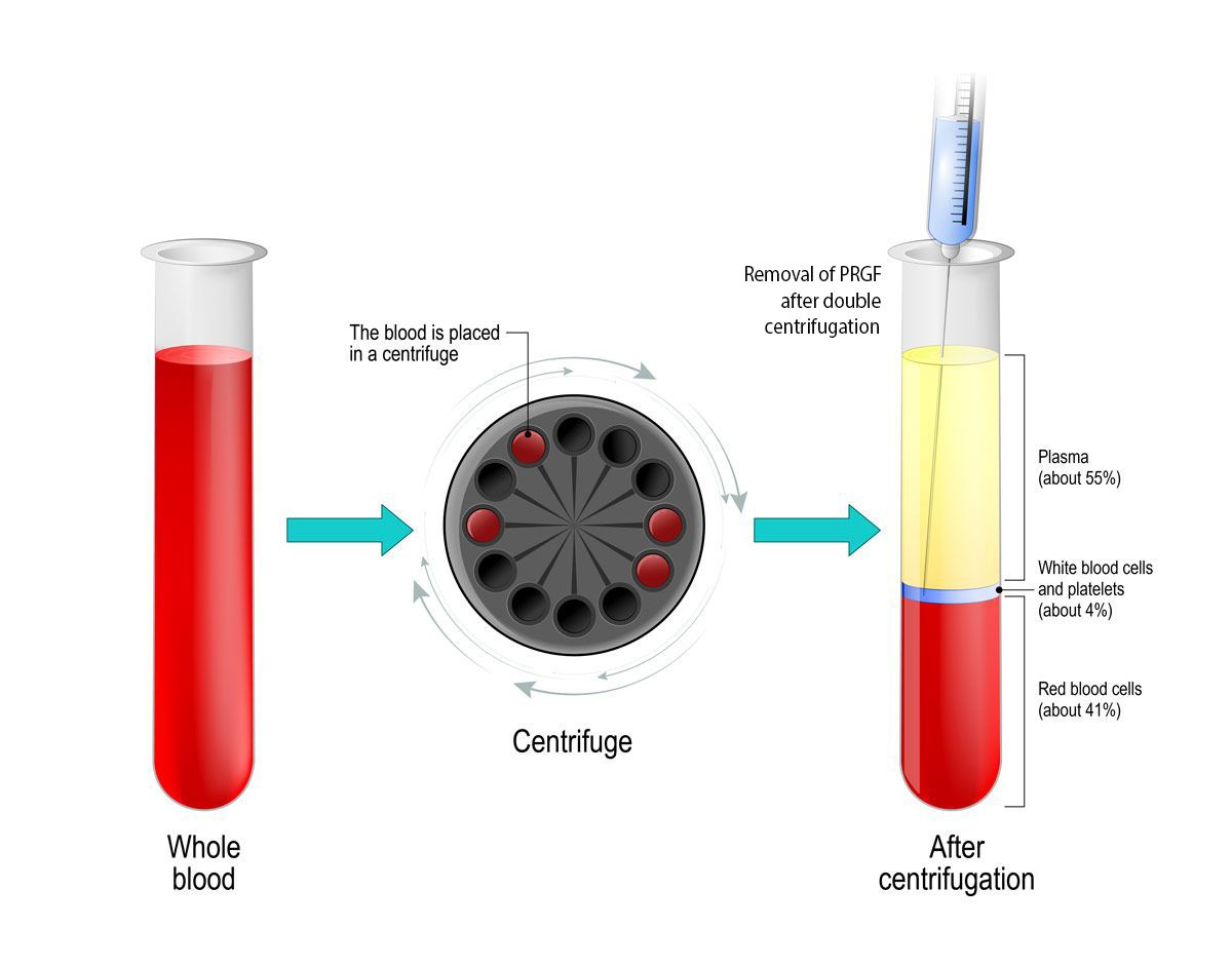 extragere plasma prgf