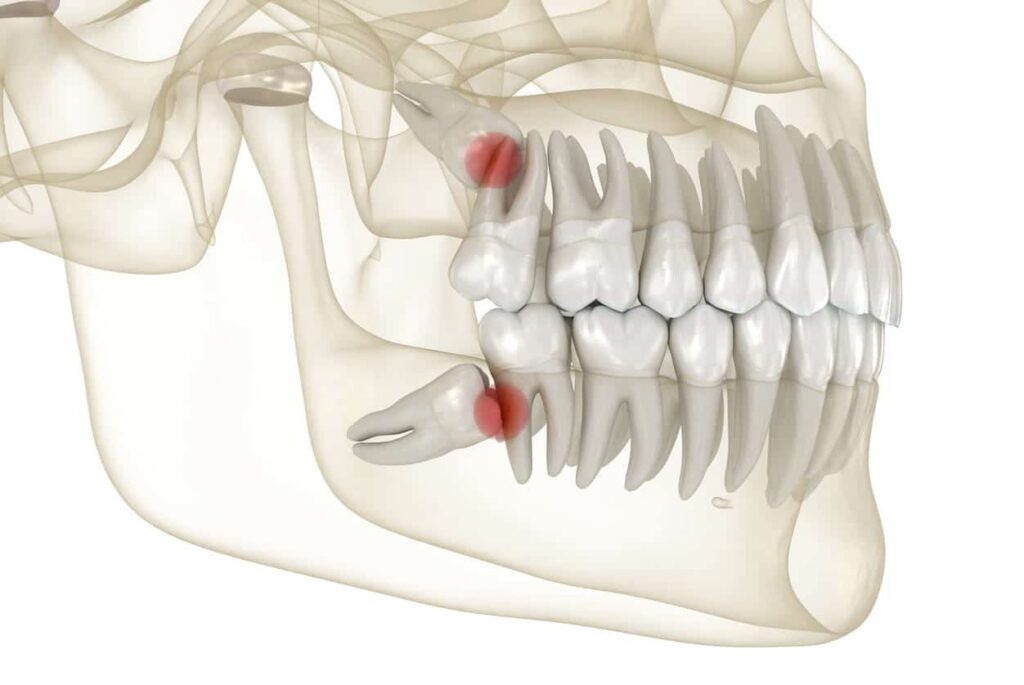 extractie molar, extractie dinte, extractie masea de minte