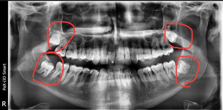 radiografie masea de minte