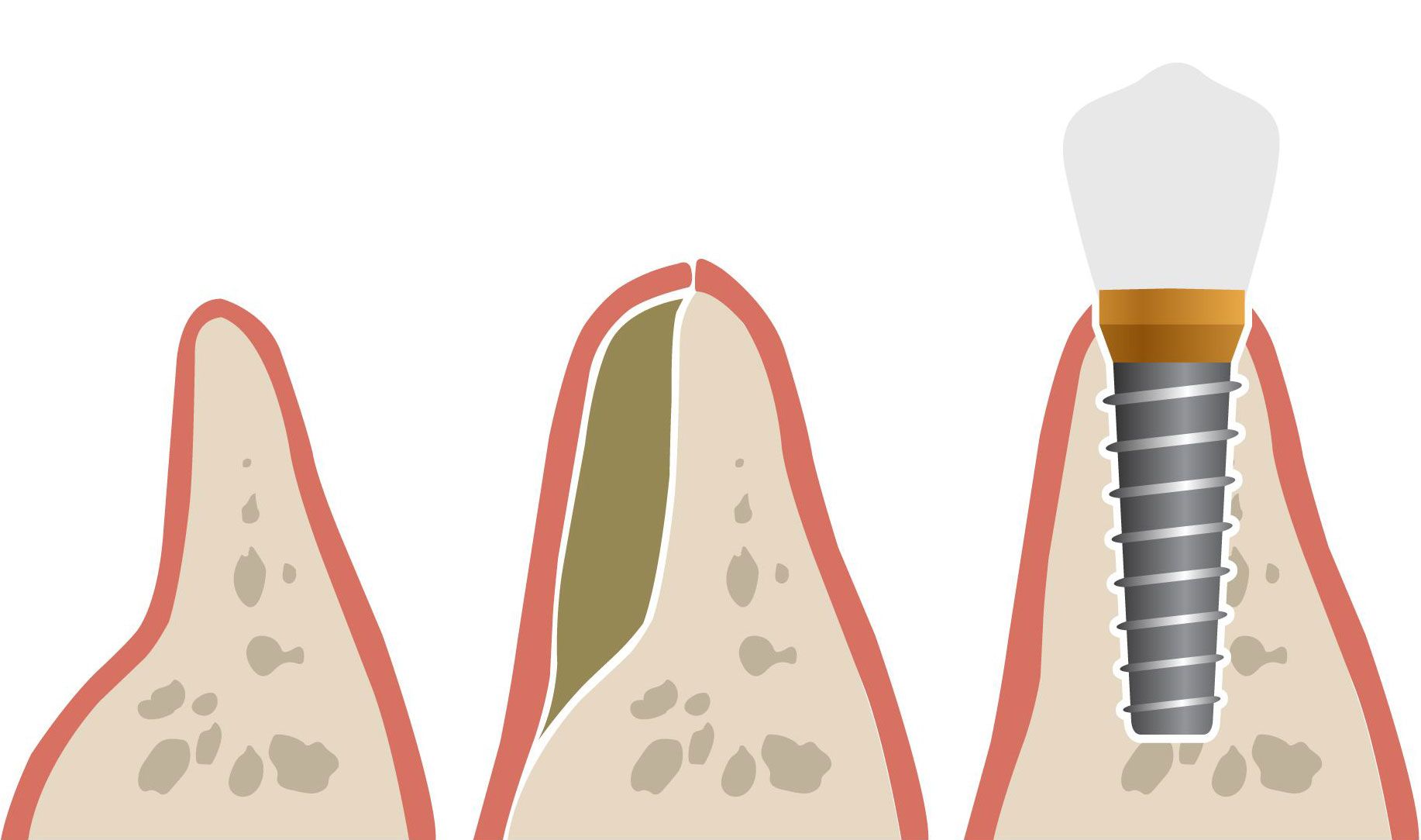 implant dentar, bont si coroana