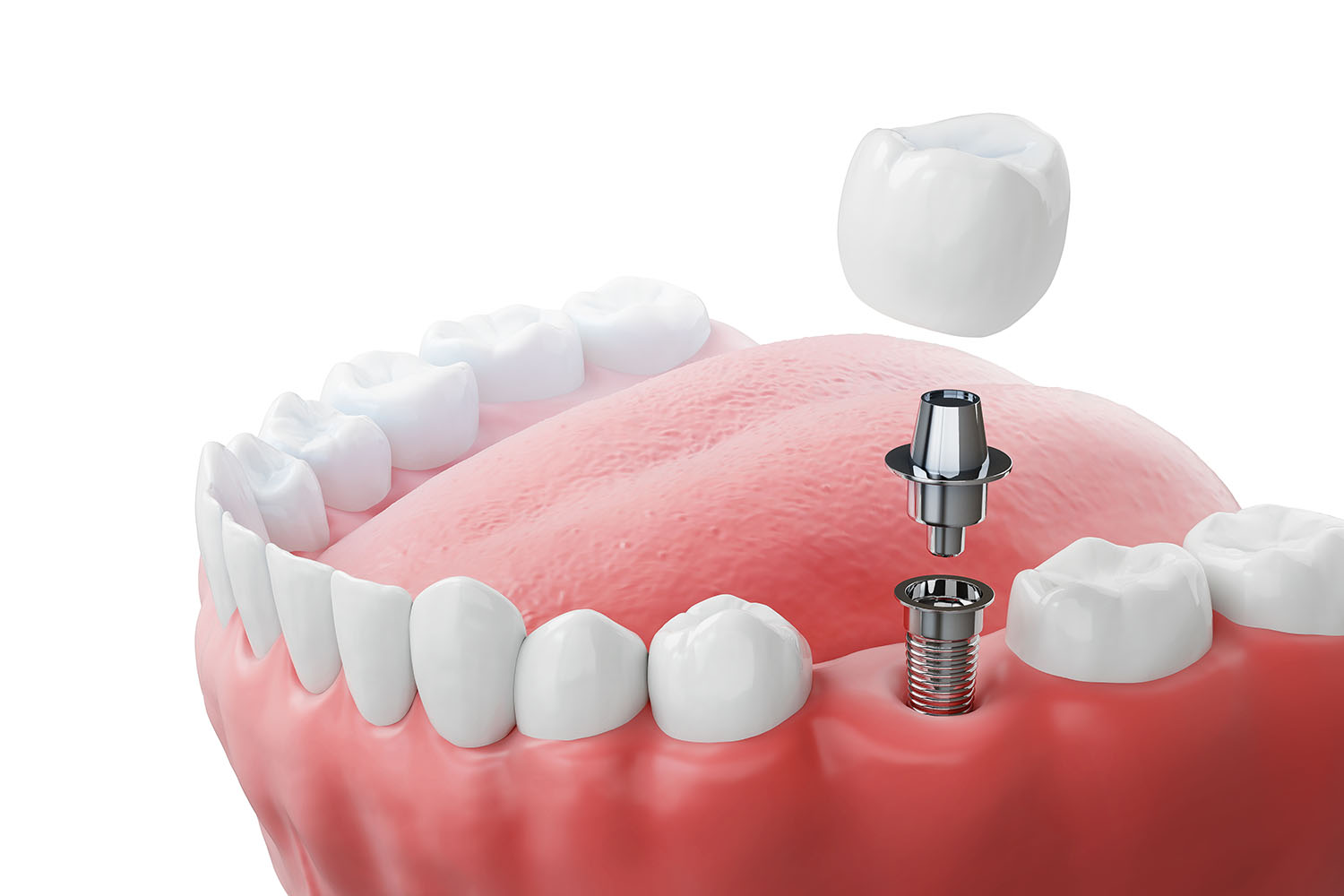 implant dentar si coroana dentara 3d