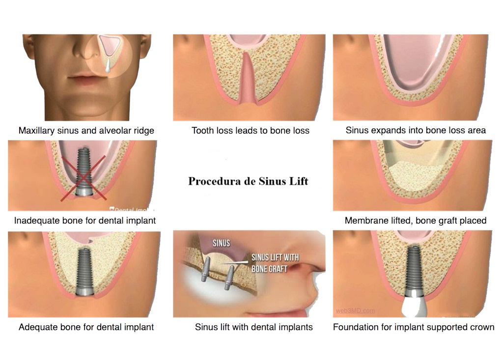 sinus lifting inserare implant dentar